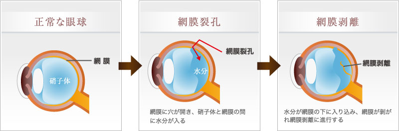 網膜剥離とはどんな病気？