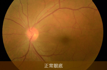 正常眼底