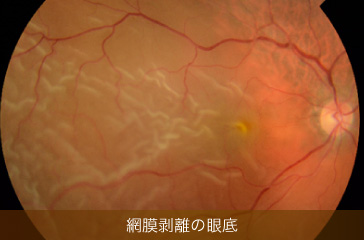 網膜剥離の眼底