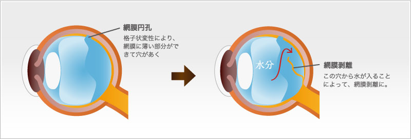 若い方に多い原因（萎縮性円孔）