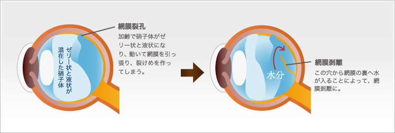 中年以降に多い原因（裂孔）