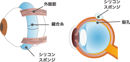 強膜バックリング（網膜復位術）