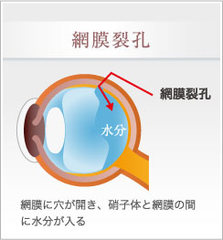 網膜剥離前段階での初期症状