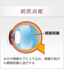 網膜剥離になった場合の症状