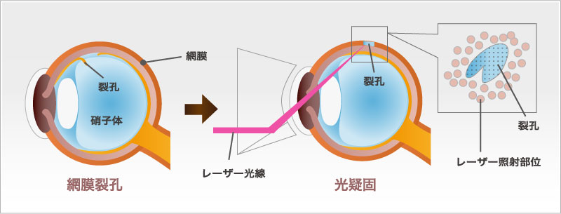 網膜光凝固術